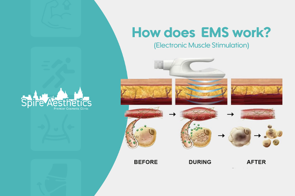 EMS treatment for post pregnancy weight loss treatment Isle of Isla