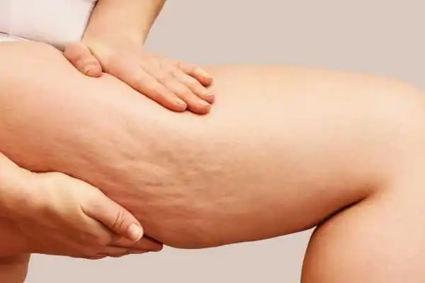 Image of woman showing leg with cellulite Isle of Isla