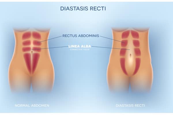 What Non-Surgical Options Are Available for Diastasis Recti Isle of Isla?