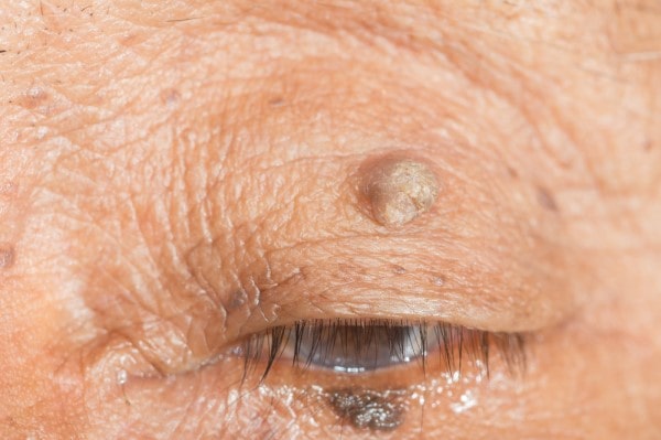 Skin imperfections Isle of Isla - Cryopen is fast and effective book in today!