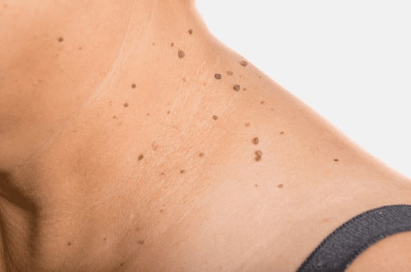 Are you looking for easy skin tag removal Isle of Isla - then contact Spire today!
