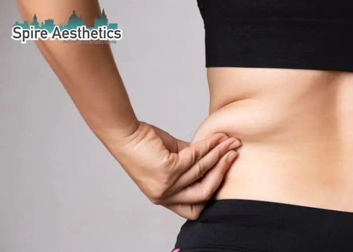 Image of woman pinching fat on their hips Isle of Isla. Fat Freezing treatment 