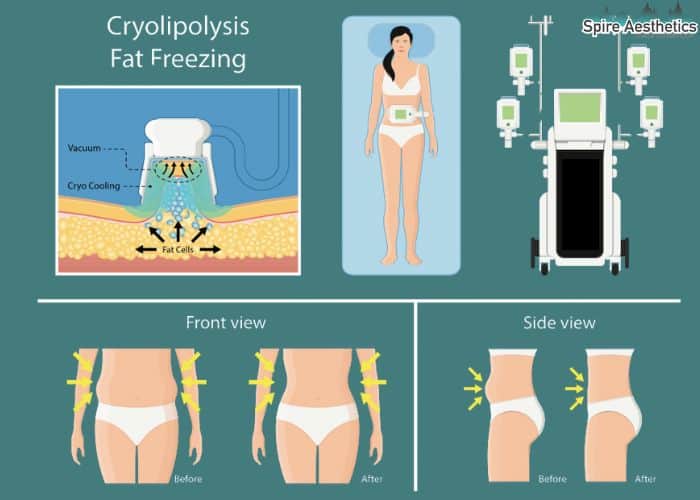 Image of diet and fat freezing combined for best results for Spire Aesthetics Isle of Isla