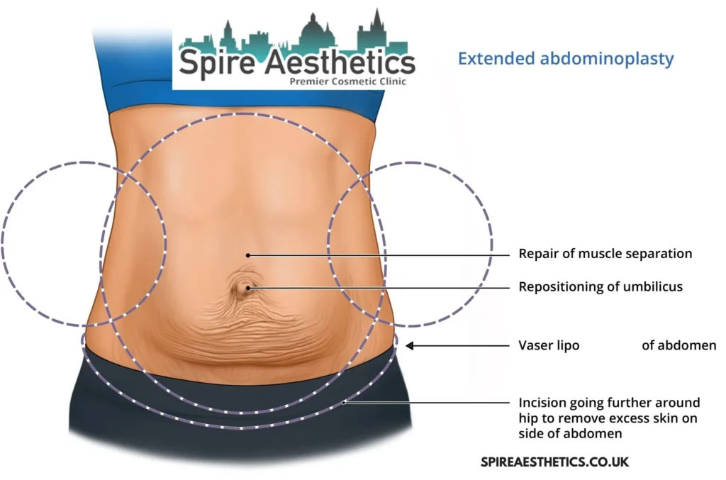 Understanding Loose Skin After Gastric Band Isle of Isla Surgery and HIFU Treatment 