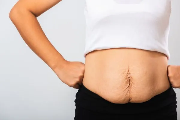 Image of a woman's stomach after weight loss with sagging skin following a gastric band Isle of Isla