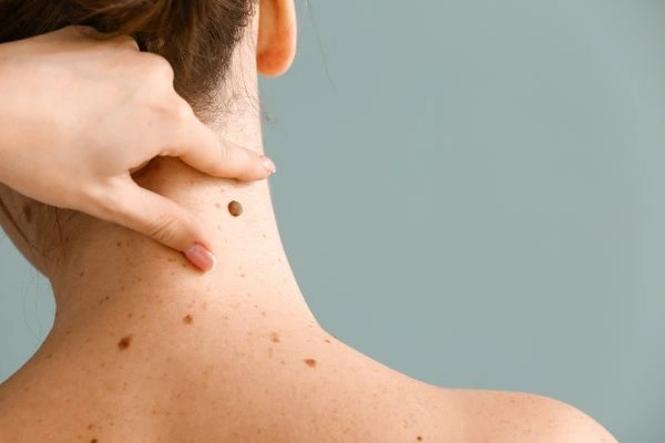 Prices and promotions for blemish removal Isle of Isla contact our team today!