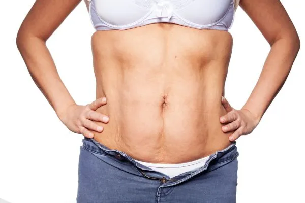 sagging skin on woman's stomach after weight loss injections Isle of Isla