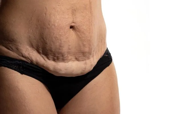 Image of womans stomach after weight loss injections Isle of Isla showing saggy skin