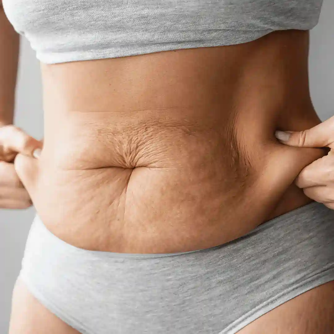 Is It Normal to Have Loose Skin After Pregnancy Isle of Isla?
