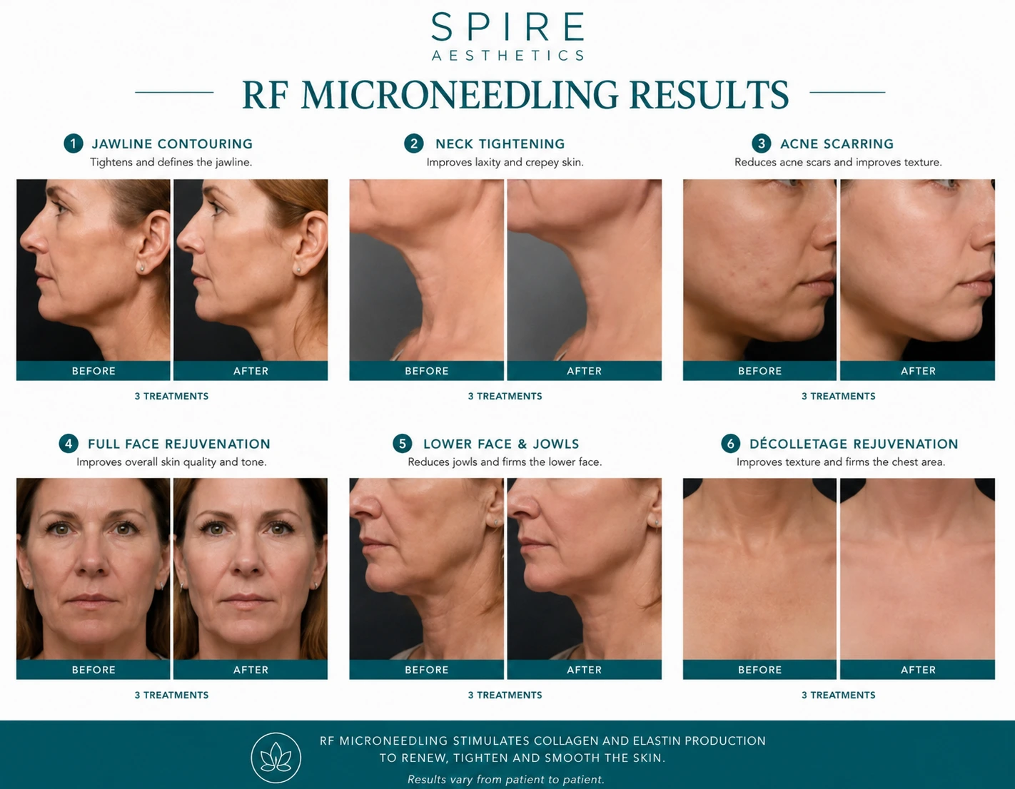 RF Microneedling Skin tightening Isle of Isla results