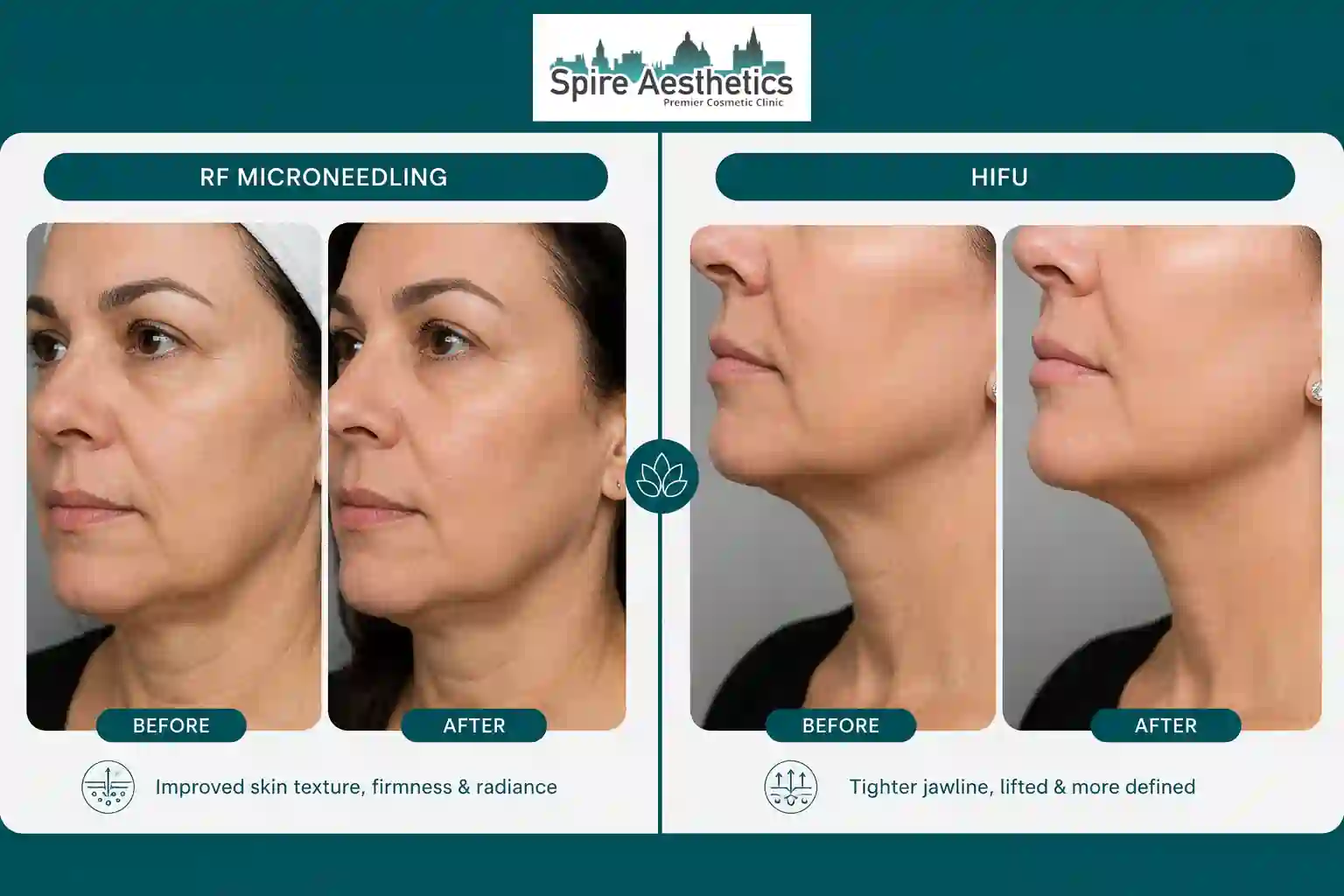 Can RF Microneedling and HIFU Be Combined Isle of Isla?