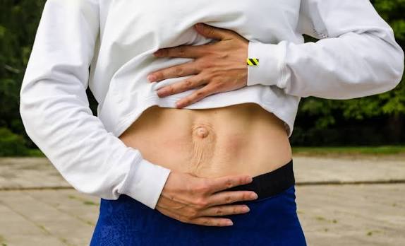 When Could Diastasis Recti Be the Missing Piece of the Puzzle Isle of Isla?