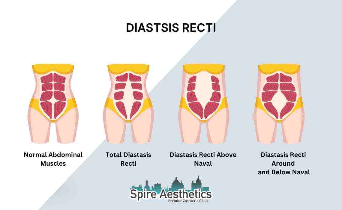 Is Non-Surgical Diastasis Recti Treatment Right for You? Common Concerns Answered Isle of Isla